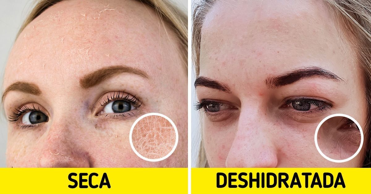 Piel deshidratada: fotos reales y consejos para cuidar 2 piel deshidratada fotos reales y consejos para cuidar 1